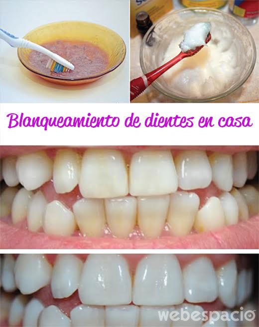 blanqueamiento-de-dientes-en-casa